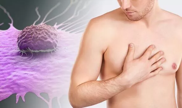 male breast cancer