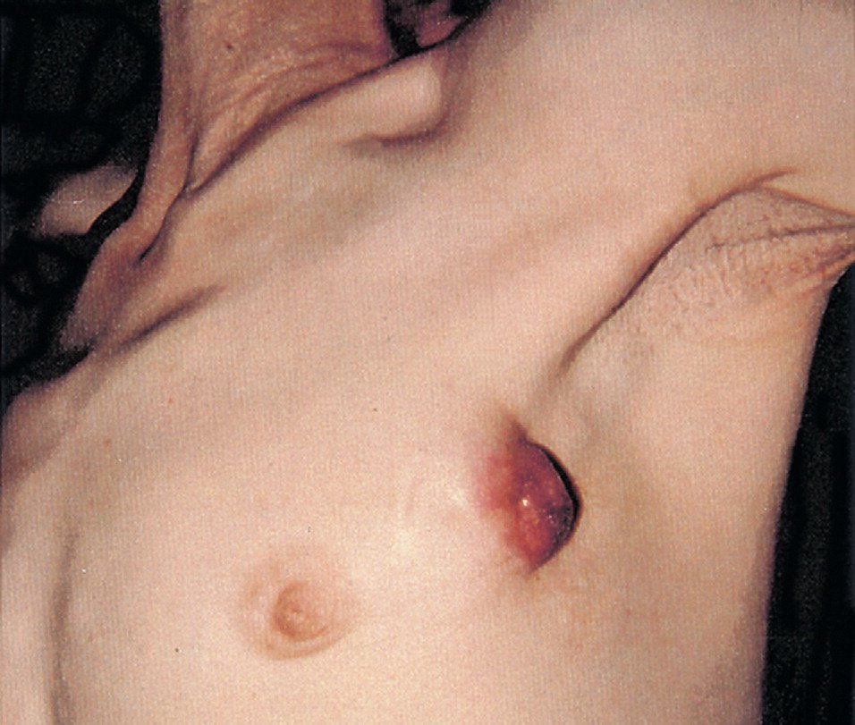 MALE BREAST CANCER
