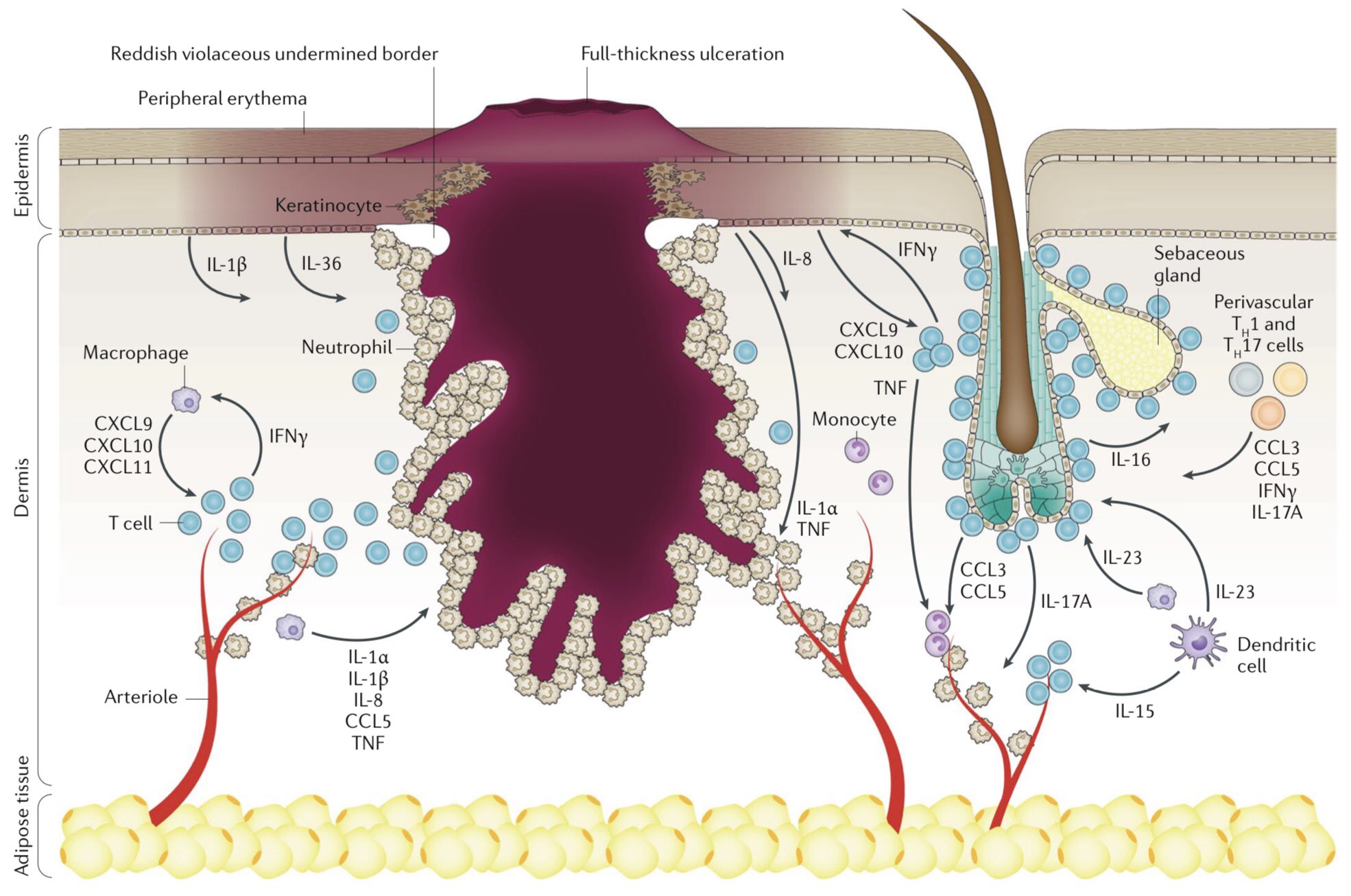 Unlocking the Mysteries Pyoderma Gangrenosum - Health Tips by Dr Zahid